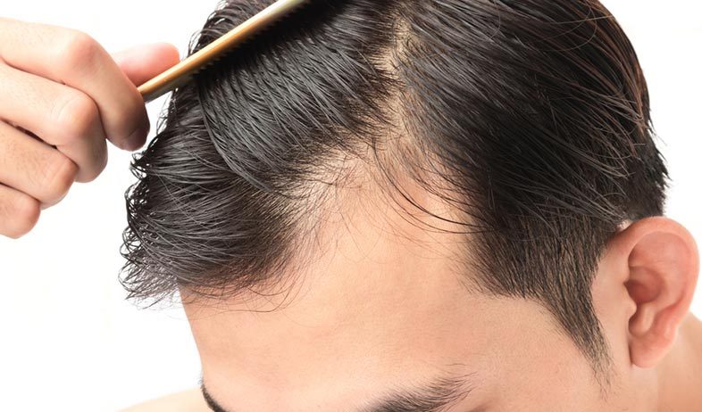 hair-transplant-alami